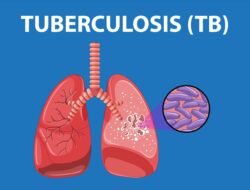 2 Tahun Terakhir, Temuan Kasus Tuberkulosis di Jabar Selalu 100 Persen