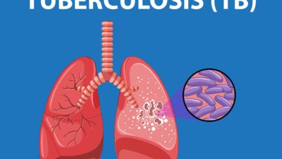 2 Tahun Terakhir, Temuan Kasus Tuberkulosis di Jabar Selalu 100 Persen